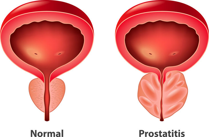Vergelijking tussen normale prostaat en prostatitis