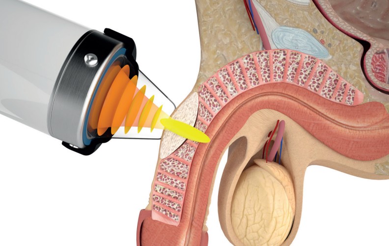 Shockwave therapie bij de ziekte van Peyronie