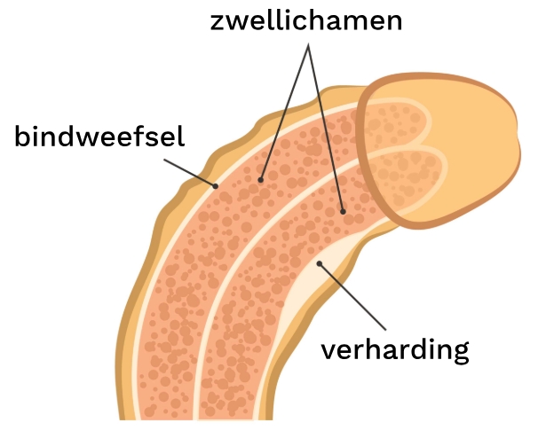 Illustratie van verharding en zwellichamen bij de ziekte van Peyronie