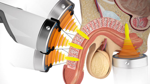 Shockwave therapie bij erectieproblemen